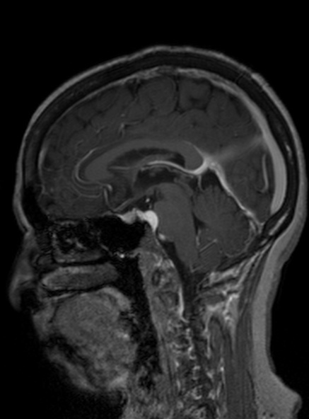 Clival meningioma (Radiopaedia 53278-59248 Sagittal T1 C+ 261).jpg