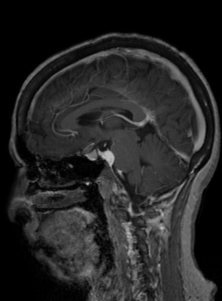 File:Clival meningioma (Radiopaedia 53278-59248 Sagittal T1 C+ 265).jpg