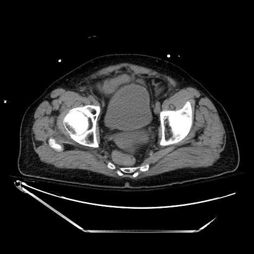 File:Closed loop obstruction due to adhesive band, resulting in small bowel ischemia and resection (Radiopaedia 83835-99023 Axial non-contrast 139).jpg