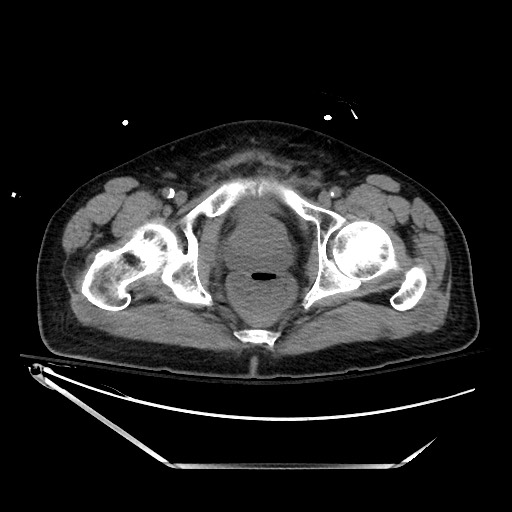 File:Closed loop obstruction due to adhesive band, resulting in small bowel ischemia and resection (Radiopaedia 83835-99023 Axial non-contrast 150).jpg