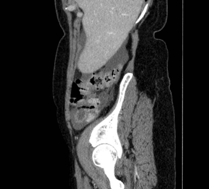 Closed loop small bowel obstruction (Radiopaedia 71211-81508 C 4).jpg