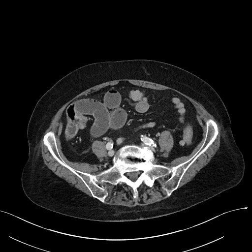 File:Closed loop small bowel obstruction - adhesions (Radiopaedia 59269-66611 Axial 26).jpg