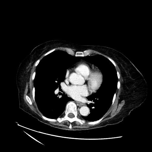 File:Closed loop small bowel obstruction due to adhesive band, with intramural hemorrhage and ischemia (Radiopaedia 83831-99017 Axial 173).jpg