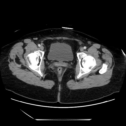 Closed loop small bowel obstruction due to adhesive bands - early and late images (Radiopaedia 83830-99014 A 147).jpg