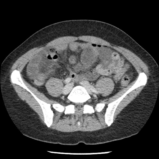 File:Closed loop small bowel obstruction due to trans-omental herniation (Radiopaedia 35593-37109 A 59).jpg