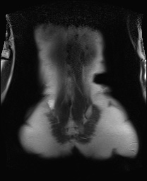 File:Closed loop small bowel obstruction in pregnancy (MRI) (Radiopaedia 87637-104031 Coronal T2 49).jpg