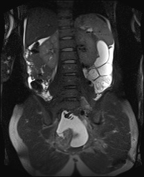 File:Closed loop small bowel obstruction in pregnancy (MRI) (Radiopaedia 87637-104031 Coronal T2 fat sat 39).jpg