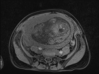 Closed loop small bowel obstruction in pregnancy (MRI) (Radiopaedia 87637-104031 F 29).jpg