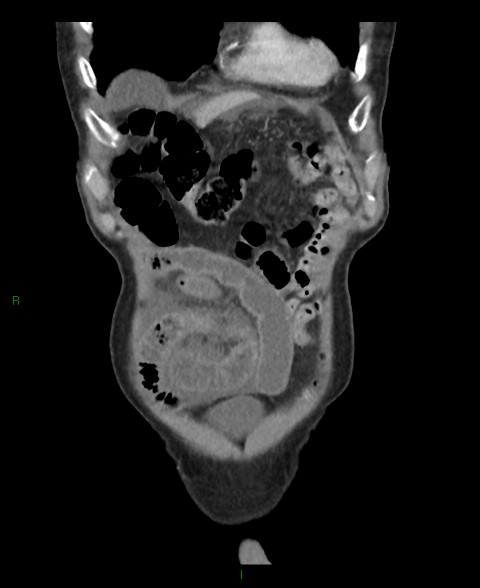 Closed loop small bowel obstruction with ischemia (Radiopaedia 84180-99456 B 57).jpg