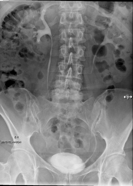 File:Cobra head sign - intravenous urogram (Radiopaedia 46539-50992 D 1).jpg
