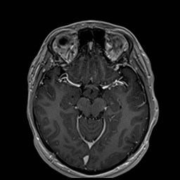 Cochlear incomplete partition type III associated with hypothalamic hamartoma (Radiopaedia 88756-105498 Axial T1 C+ 87).jpg