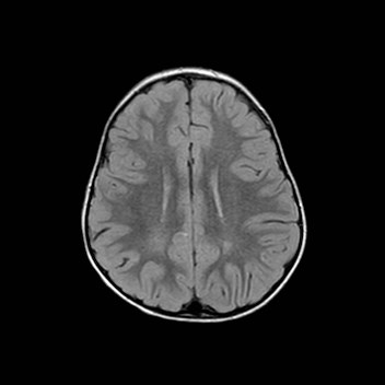 File:Cochlear nerve aplasia - unilateral (Radiopaedia 87910-104413 Axial FLAIR 24).jpg