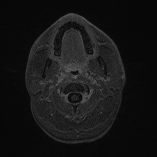 File:Colloid cyst (Radiopaedia 44510-48181 Axial T1 C+ 5).png