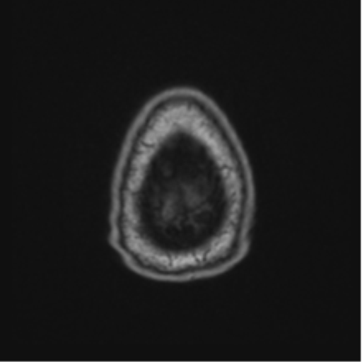 File:Colloid cyst of the third ventricle (Radiopaedia 86571-102662 Axial T1 74).png