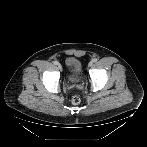 Colocolic intussusception due to lipoma (Radiopaedia 73712-84508 A 106).jpg