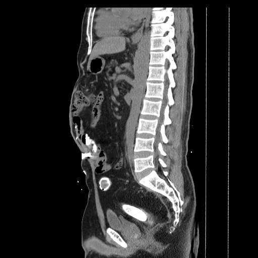 Colocutaneous fistula in Crohn's disease (Radiopaedia 29586-30093 F 19).jpg