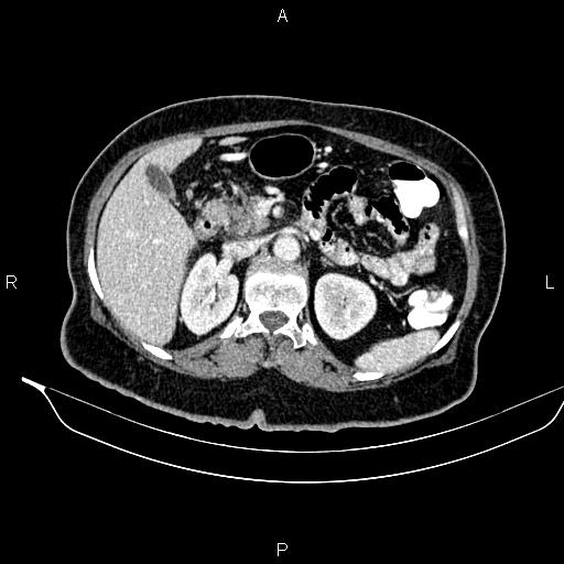 Colon adenocarcinoma (Radiopaedia 91240-108842 A 29).jpg