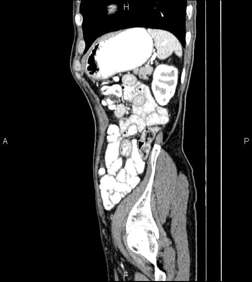 Colon adenocarcinoma - hepatic flexure (Radiopaedia 85635-101395 D 73).jpg