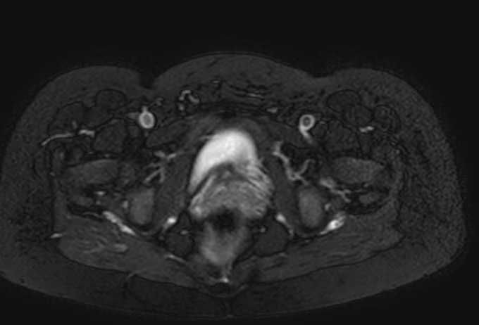 Colon adenocarcinoma with Krukenberg tumors, advanced pregnancy (Radiopaedia 67279-76645 Axial T2 SPAIR 4).jpg