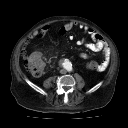 File:Colon cancer with duodenal invasion (Radiopaedia 16278-15958 A 37).jpg