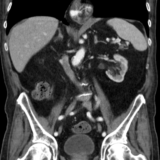 File:Colon cancer with duodenal invasion (Radiopaedia 16278-15958 B 35).jpg