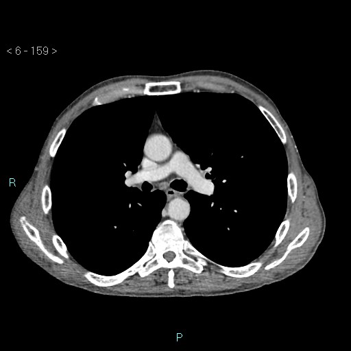 Colonic cancer (ultrasound and TC imaging) (Radiopaedia 50346-55713 B 159).jpg