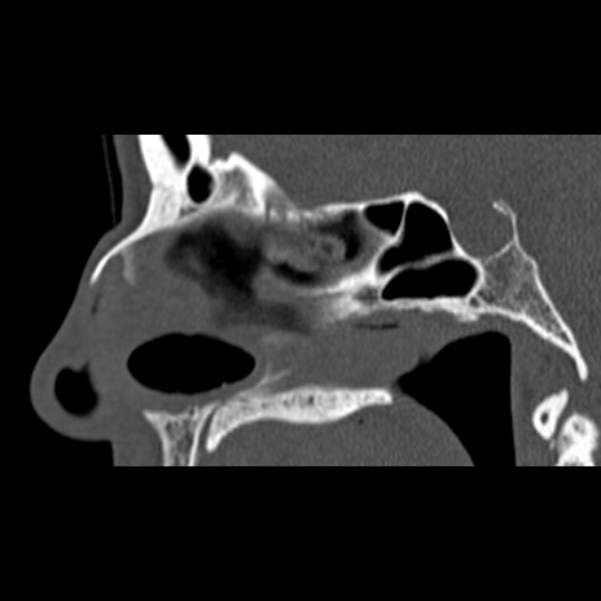 Nasal septal perforation (Radiopaedia 25030-25289 Sagittal bone window 28).jpg