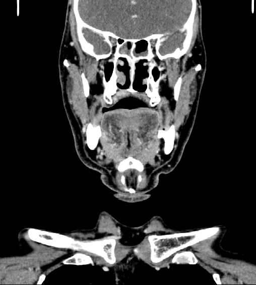 File:Nasopharyngeal carcinoma - infiltrating the clivus (Radiopaedia 62583-70875 D 13).jpg