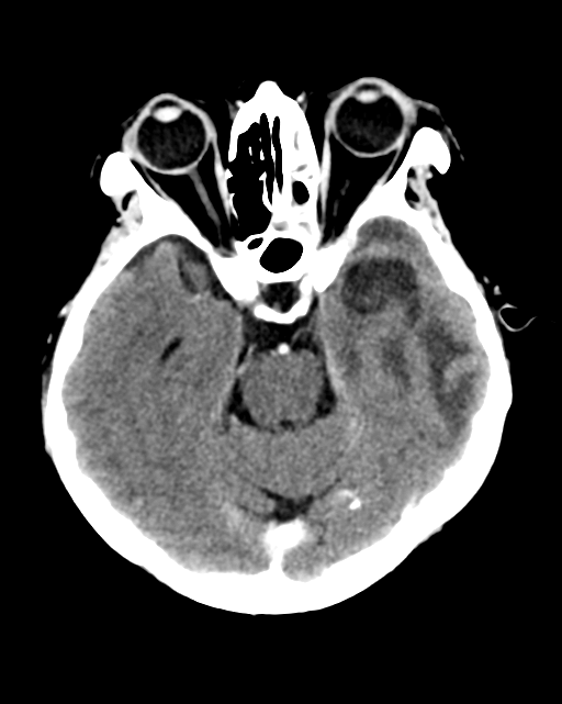 Nasopharyngeal carcinoma with cerebral abscess (Radiopaedia 43018-46275 Axial C+ delayed 19).png