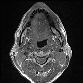 File:Nasopharyngeal carcinoma with skull base invasion (Radiopaedia 59258-66600 B 35).jpg