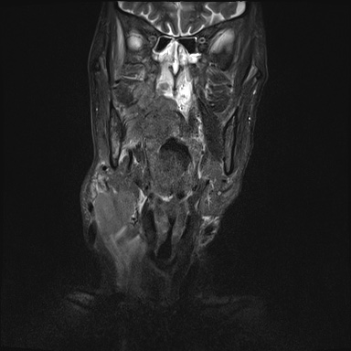 Nasopharyngeal carcinoma with skull base invasion (Radiopaedia 59258-66600 Coronal T2 fat sat 24).jpg