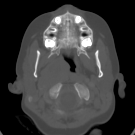 File:Nasopharyngeal rhabdomyosarcoma (Radiopaedia 23417-23491 Axial bone window 3).jpg