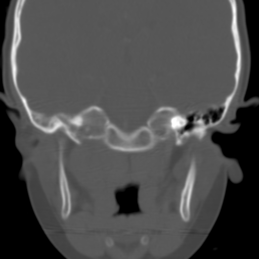 File:Nasopharyngeal rhabdomyosarcoma (Radiopaedia 23417-23491 Coronal bone window 5).jpg