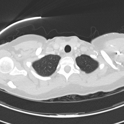 Necrobiotic pulmonary nodules - Crohn disease (Radiopaedia 20723-20631 Axial lung window 14).jpg