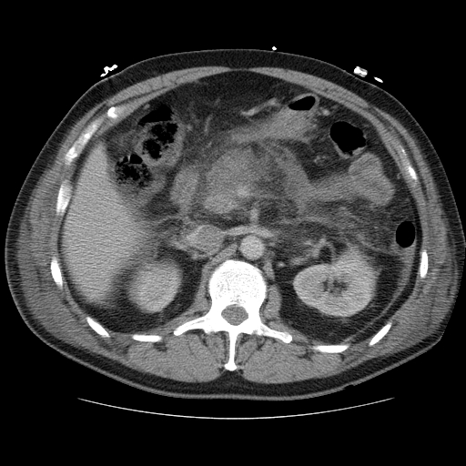 File:Necrotizing pancreatitis - acute necrotic collection maturing into walled-off pancreatic necrosis (Radiopaedia 9602-10249 A 6).jpg