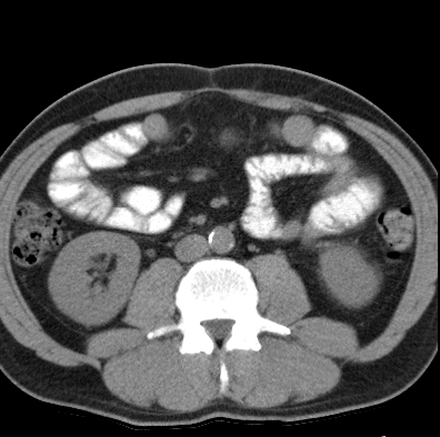 File:Necrotizing pancreatitis with acute necrotic collection (Radiopaedia 14470-14417 Axial non-contrast 28).jpg