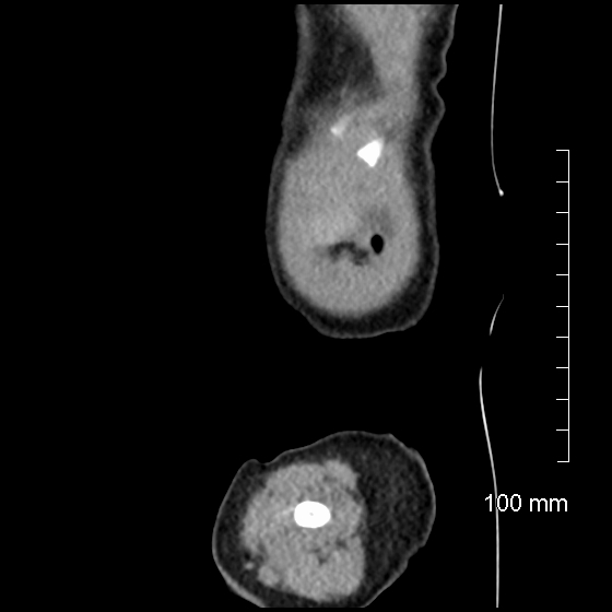 File:Neonatal neuroblastoma (Radiopaedia 56651-63438 C 13).jpg