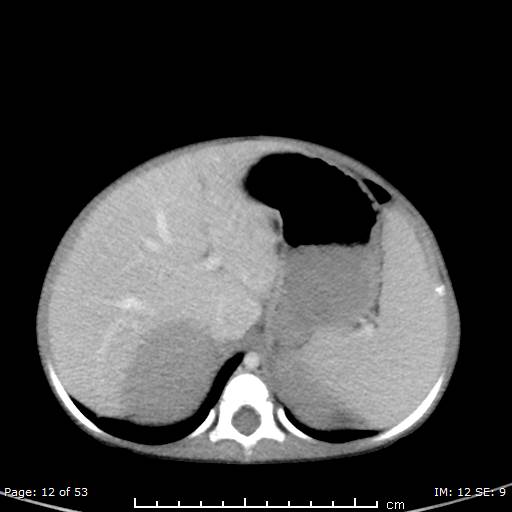 File:Nephroblastomatosis (Radiopaedia 41934-44935 A 12).jpg
