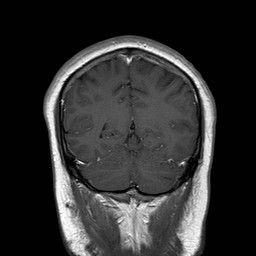 File:Neuro-Behcet's disease (Radiopaedia 21557-21505 Coronal T1 C+ 17).jpg