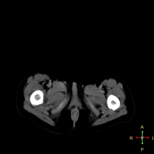 File:Neuroblastoma (Radiopaedia 24751-25016 D 50).jpg