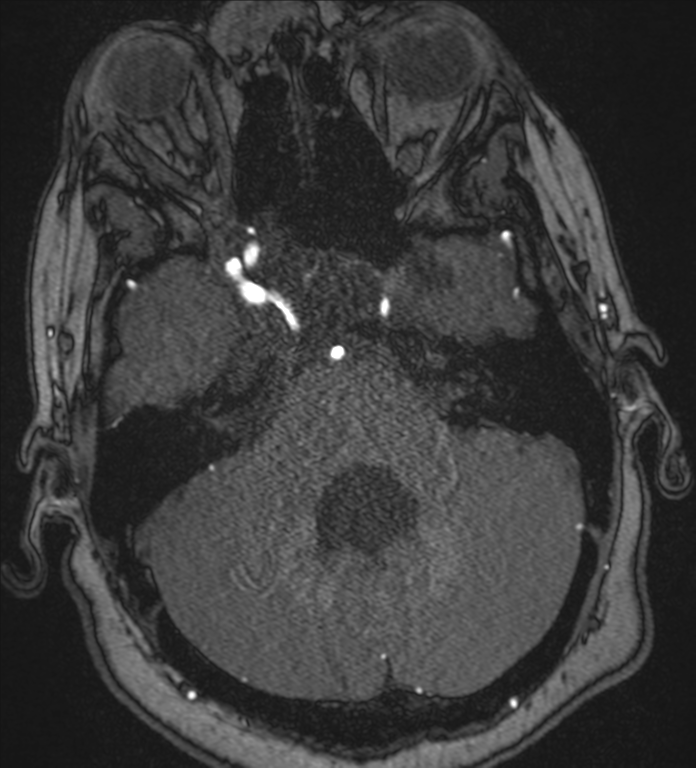 Neurofibromatosis type 1 - head and neck - CNS manifestations (Radiopaedia 49910-55188 Axial MRA 17).png