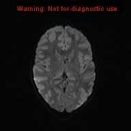 File:Neurofibromatosis type 1 with optic nerve glioma (Radiopaedia 16288-15965 Axial DWI 35).jpg