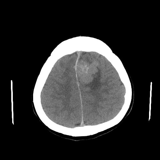 File:Neurofibromatosis type 2 (Radiopaedia 25389-25637 Axial non-contrast 21).jpg