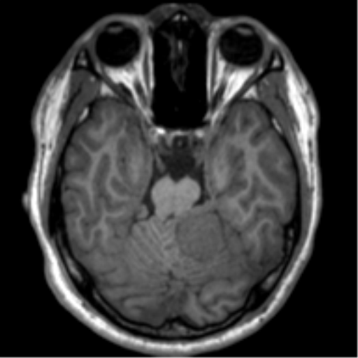 File:Neurofibromatosis type 2 (Radiopaedia 44936-48838 Axial T1 44).png