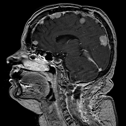 File:Neurofibromatosis type 2 (Radiopaedia 8713-9518 Sagittal T1 C+ 23).jpg