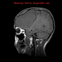 File:Neurofibromatosis type 2 (Radiopaedia 8953-9730 Sagittal T1 15).jpg