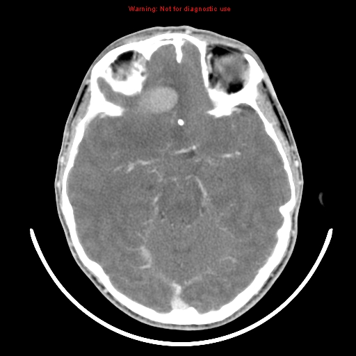 File:Neurofibromatosis type 2 (Radiopaedia 8953-9732 C 13).jpg