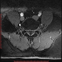 Non Hodgkin's lymphoma with metastasis to spine (Radiopaedia 54844-61103 Axial T1 C+ fat sat 3).jpg