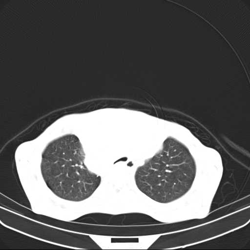 File:Non hodgkin lymphoma of the mediastinum (Radiopaedia 20814-20729 Axial lung window 14).jpg