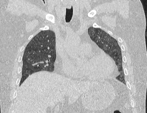 Non specific interstitial pneumonia (NSIP) (Radiopaedia 89725-106798 Coronal lung window 31).jpg